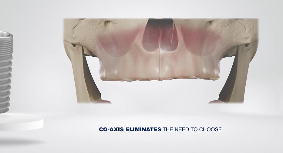 CoAxis Benefits of Features Part 1 (prosthetic emergence)